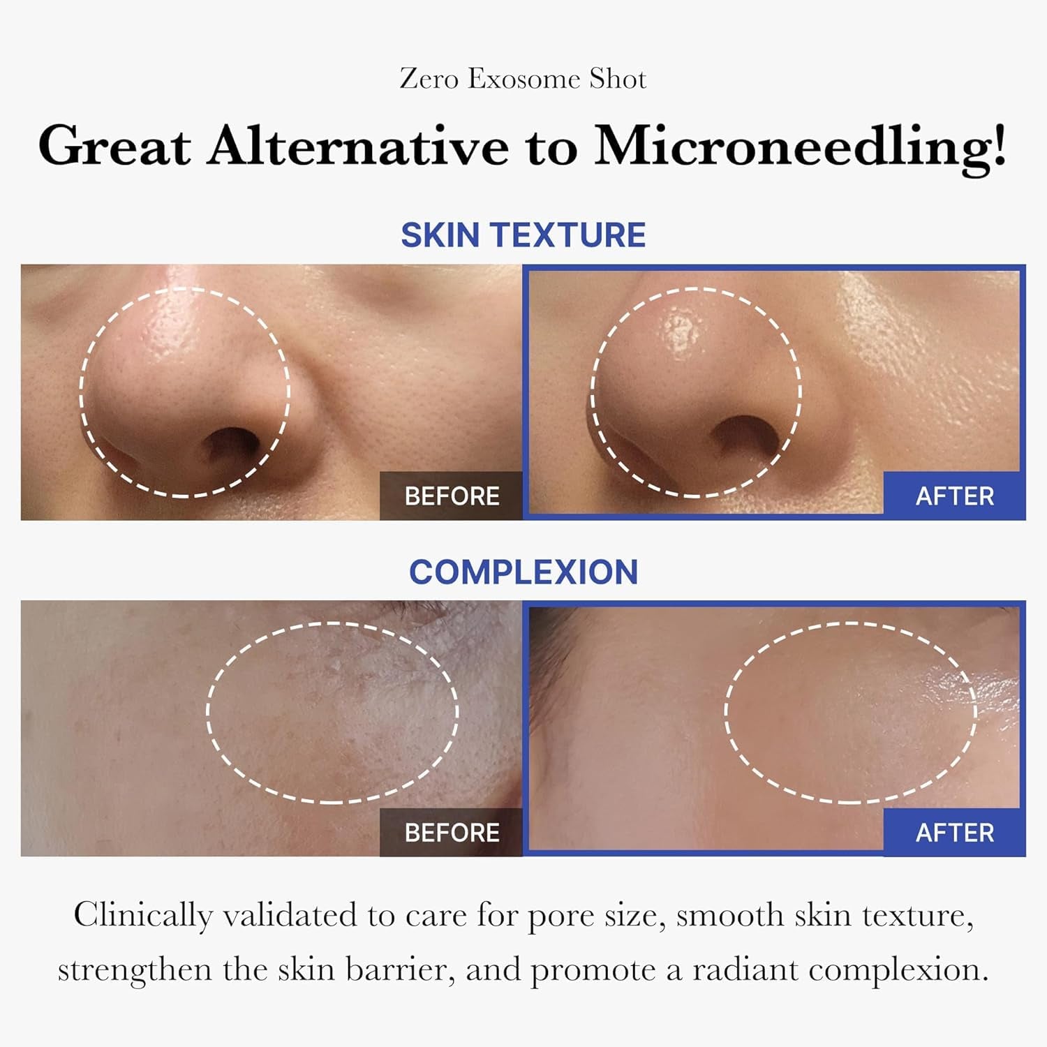 Exosome Shot Zero 2,000 PPM Spicule Facial Serum | Liquid Skin Booster Serum | Exosome, AHA+BHA+PHA | Pore Care, Dead Skin Cells, Skin Texture | Korean Skincare, 1.01 Fl.Oz